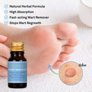 Avashine Wart Removal, Painlessly Removes Common, Hand and Plantar Wart Remover